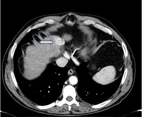 Epatocarcinoma (HCC) di 2 cm sulla cupola epatica, molto vascolarizzato (freccia)