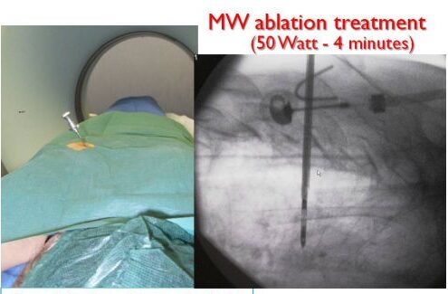 Posizionamento della cannula e termoablazione con microonde