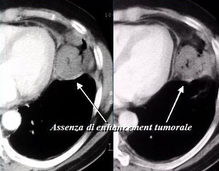 Controllo TC dopo 1 mese; necrosi completa del tumore.