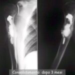 Osteoplastica omero dx