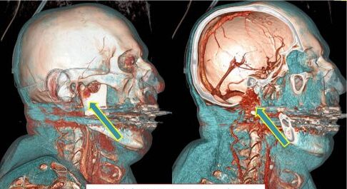 Variazione dei piani di ricostruzione per miglior visione delle metastasi.