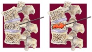 Vertebroplastica